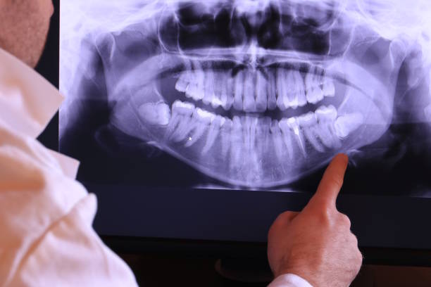 Best Emergency Dentist for Lost Fillings or Crowns in Solon, IA