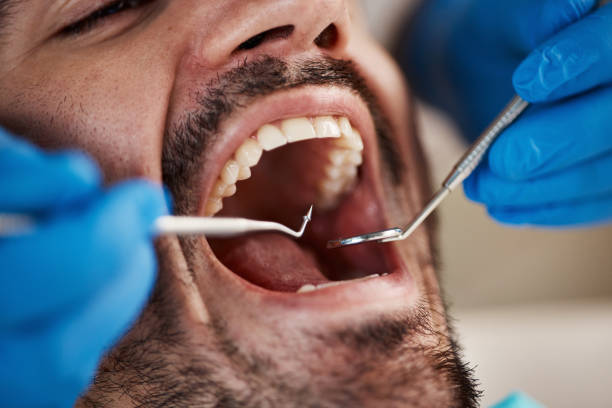 Best Emergency Dentist for Knocked-Out Tooth in Solon, IA